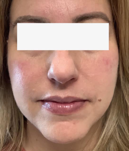 After Image: Cheek Filler - front