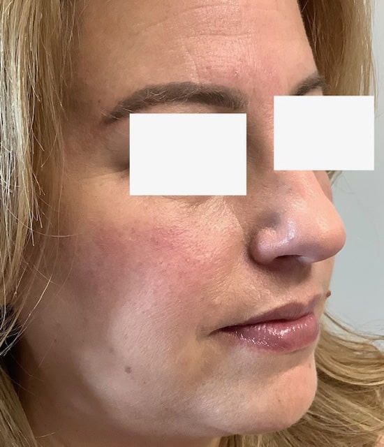 After Image: Cheek Filler - right-front-oblique