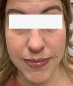 Before Image: Cheek Filler