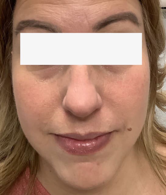 Before Image: Cheek Filler - front