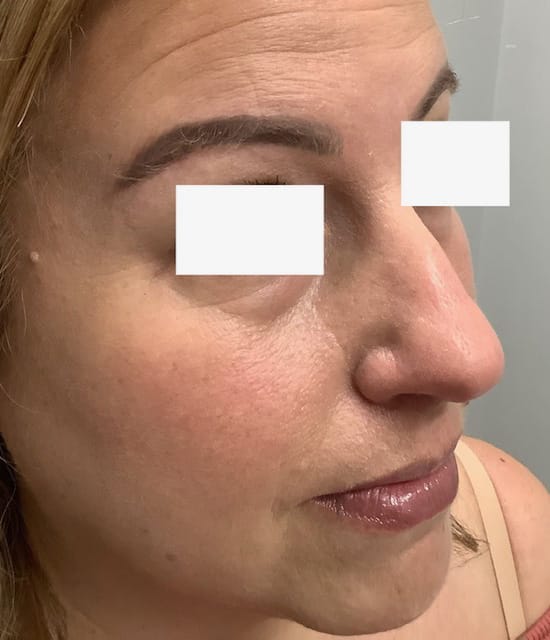 Before Image: Cheek Filler - right-front-oblique