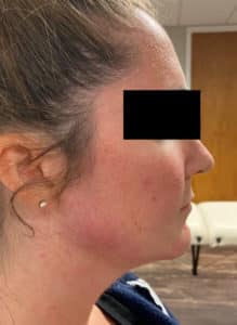 After Image: Chin & Jawline