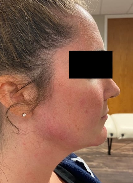 After Image: Chin & Jawline - right-side