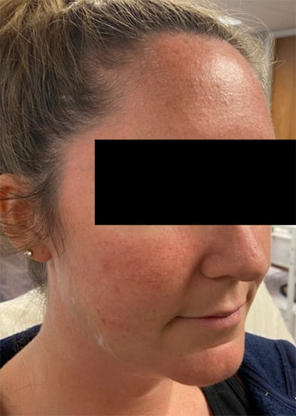 After Image: Chin & Jawline - right-front-oblique