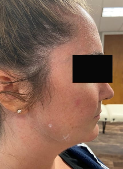 Before Image: Chin & Jawline - right-side