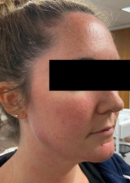 Before Image: Chin & Jawline - right-front-oblique
