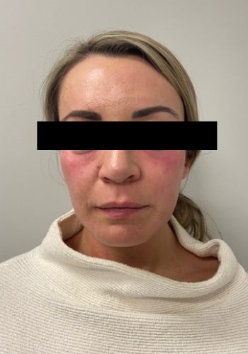 After Image: Cheek Filler - front