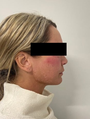 After Image: Cheek Filler - right-side