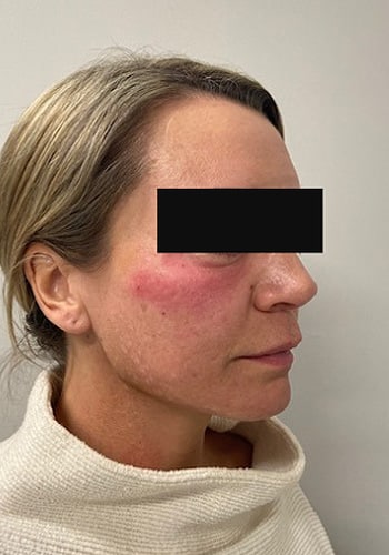After Image: Cheek Filler - right-front-oblique