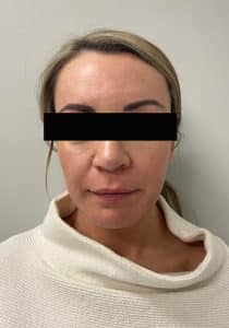 Before Image: Cheek Filler