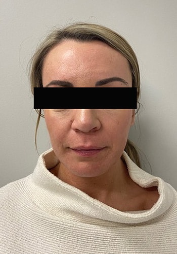 Before Image: Cheek Filler - front