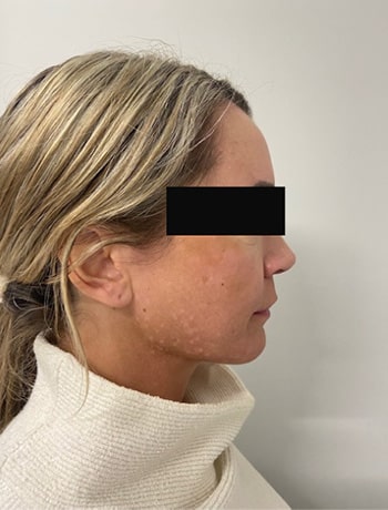 Before Image: Cheek Filler - right-side