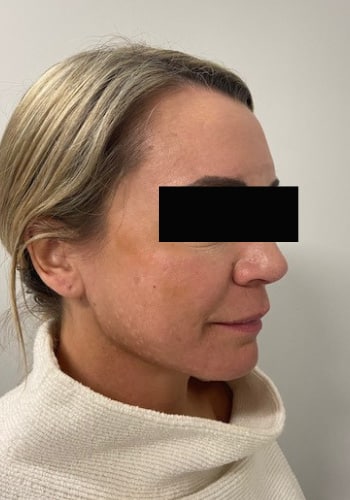 Before Image: Cheek Filler - right-front-oblique