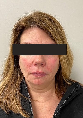 After Image: Cheeks and Lower Face Fillers - front