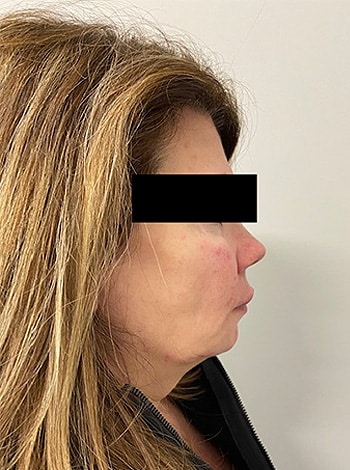 After Image: Cheeks and Lower Face Fillers - right-side