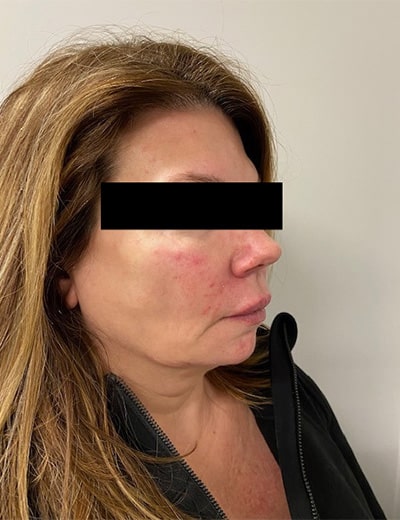 After Image: Cheeks and Lower Face Fillers - right-front-oblique