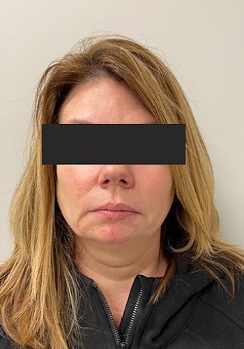 Before Image: Cheeks and Lower Face Fillers - front