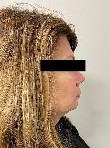 Before Image: Cheeks and Lower Face Fillers - right-side