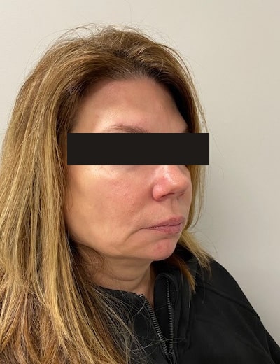 Before Image: Cheeks and Lower Face Fillers - right-front-oblique