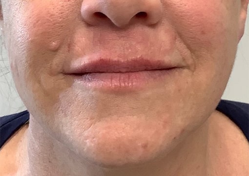 After Image: Lip & Lower Face Fillers - front