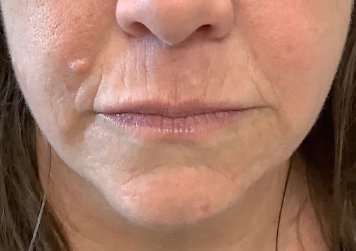 Before Image: Lip & Lower Face Fillers - front