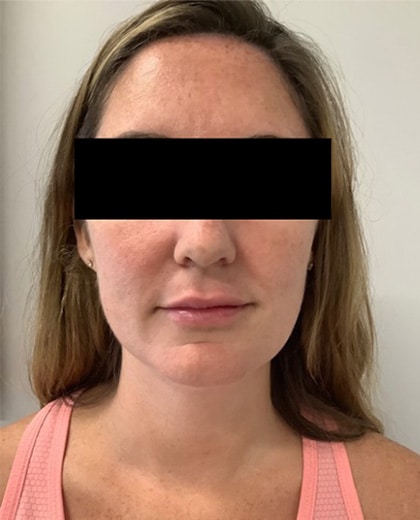 After Image: Lip Filler - front