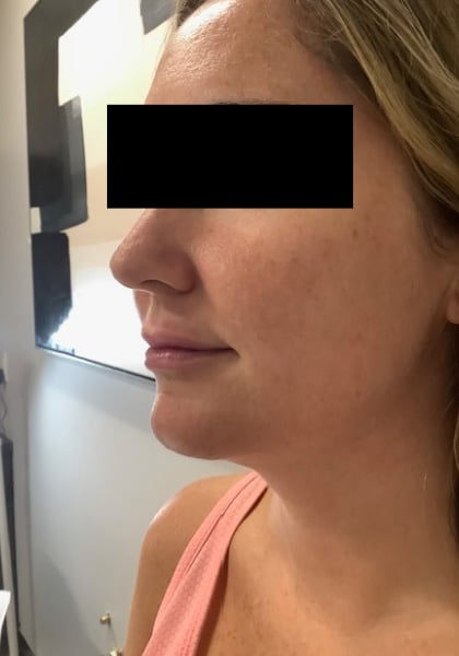 After Image: Lip Filler - left-front-oblique