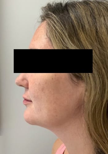 After Image: Lip Filler - left-side