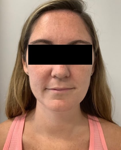 Before Image: Lip Filler - front