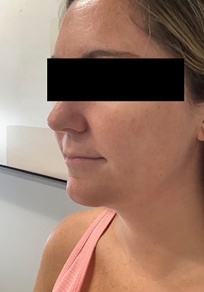 Before Image: Lip Filler - left-front-oblique