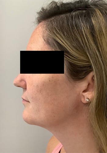 Before Image: Lip Filler - left-side