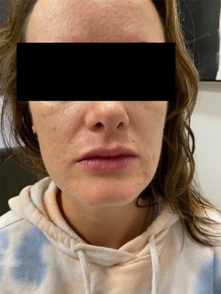 After Image: Lip Filler - front