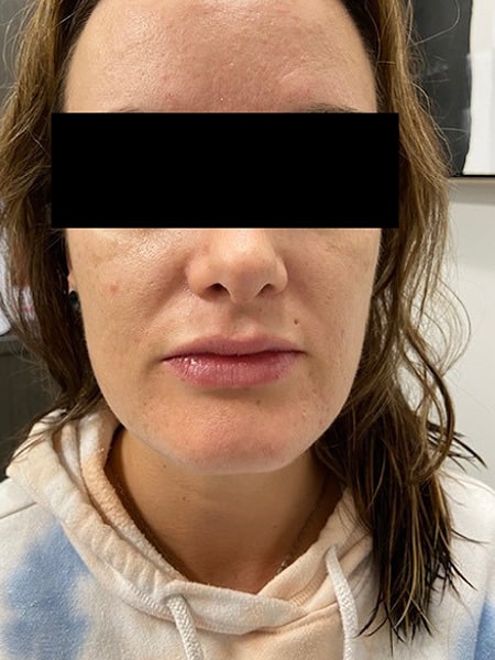 Before Image: Lip Filler - front