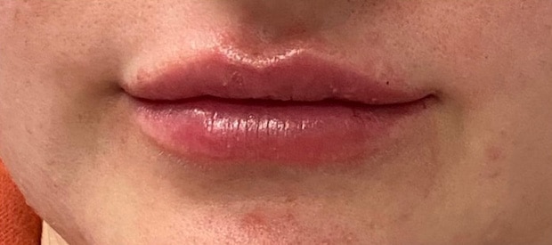 After Image: Lip Filler - front