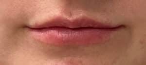 Before Image: Lip Filler