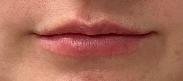 Before Image: Lip Filler - front