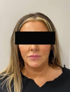 After Image: Lip Filler