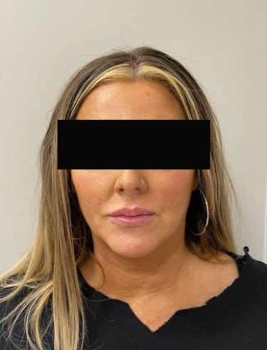 After Image: Lip Filler - front