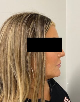 After Image: Lip Filler - right-side
