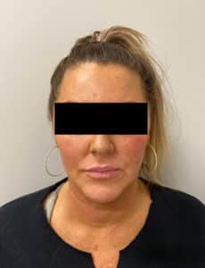 Before Image: Lip Filler