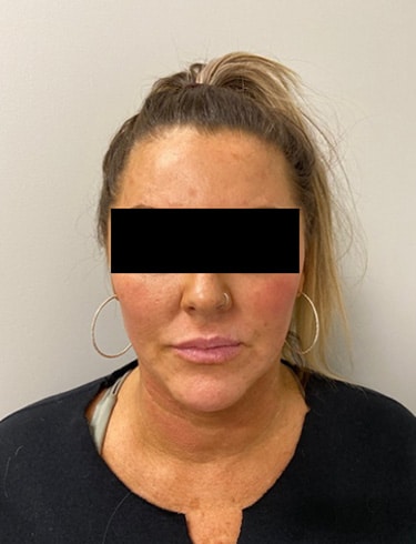 Before Image: Lip Filler - front