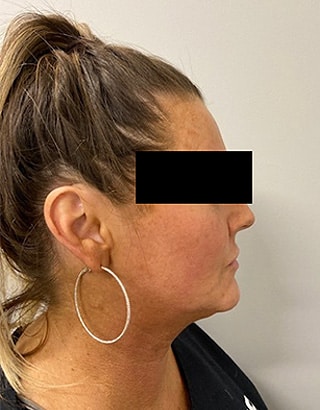 Before Image: Lip Filler - right-side