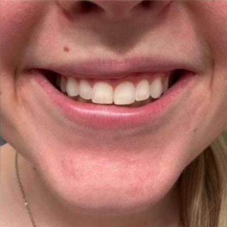 After Image: Lip Flip - front