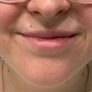 Before Image: Lip Flip - front