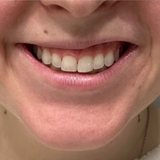 Before Image: Lip Flip - front