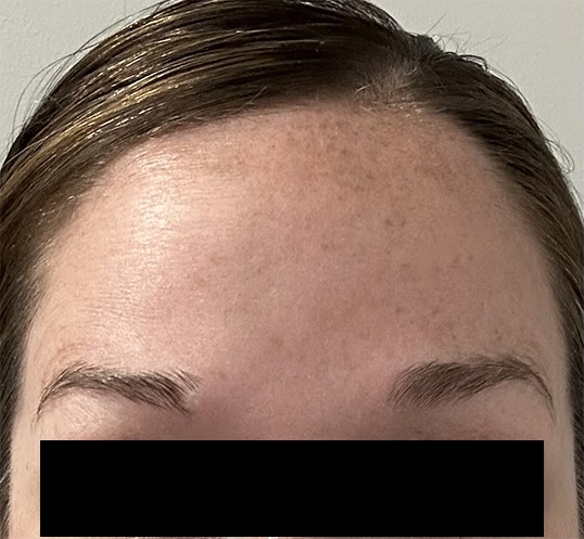 70900 botox aft 01