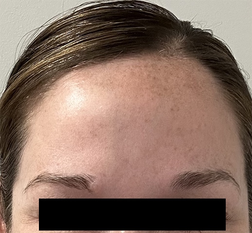 After Image: Botox - front
