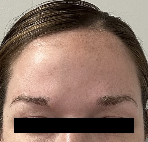 After Image: Botox - front
