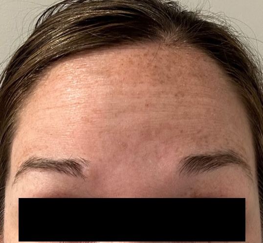 70900 botox bef 01