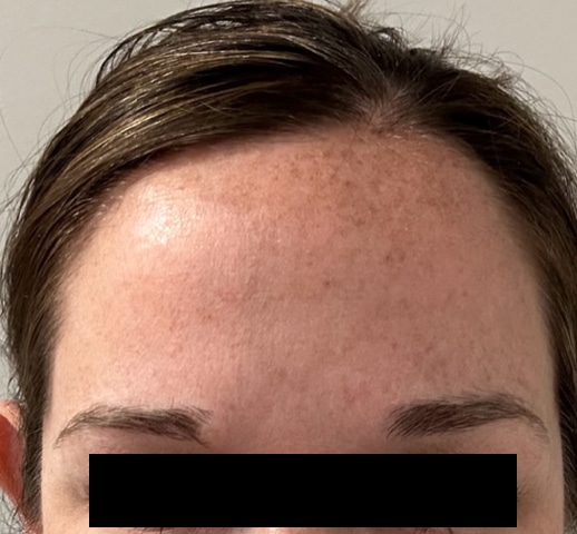 Before Image: Botox - front